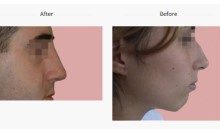 affordable-rhinoplasty-in-poland-with-europe-surgery