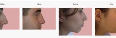 affordable-rhinoplasty-in-poland-with-europe-surgery