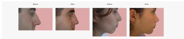 affordable-rhinoplasty-in-poland-with-europe-surgery